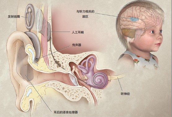 人工耳蜗原理图