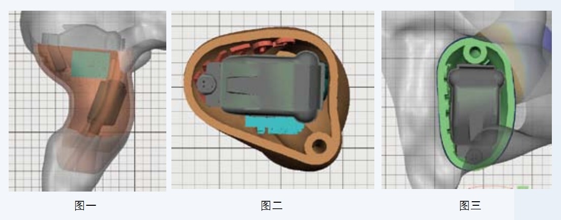 深耳道式助听器耳道入口狭窄